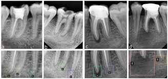 Rontgen Gigi Periapikal