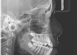 Rontgen Cephalometry